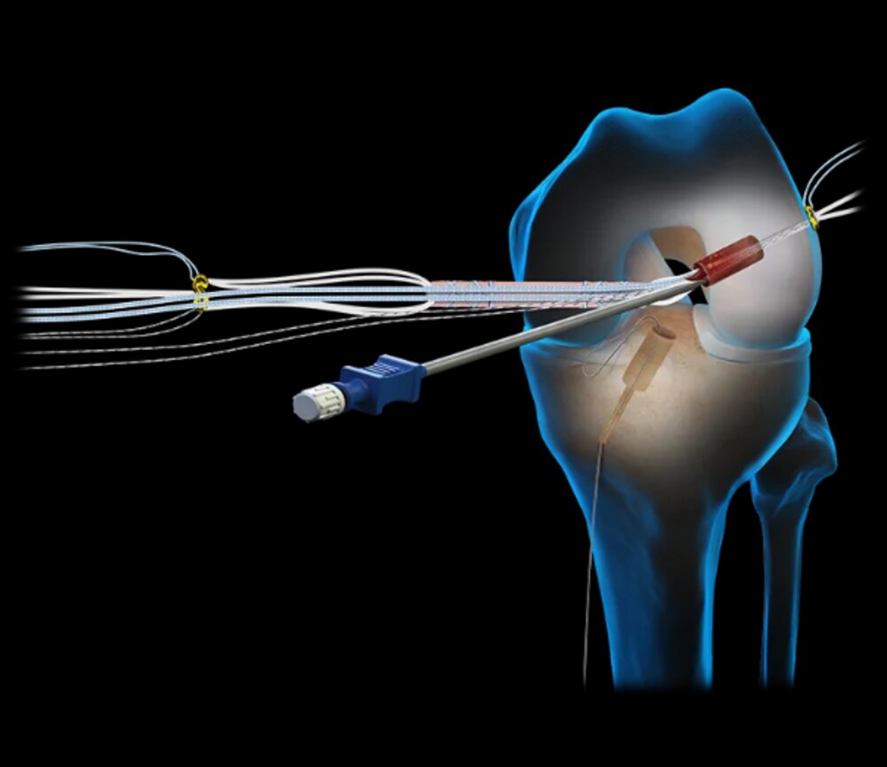 Illustration of BioACL reconstruction with the Soft Button TightRope